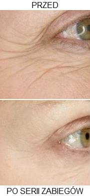 Karboskyterapia efekt oczy - Viola studio